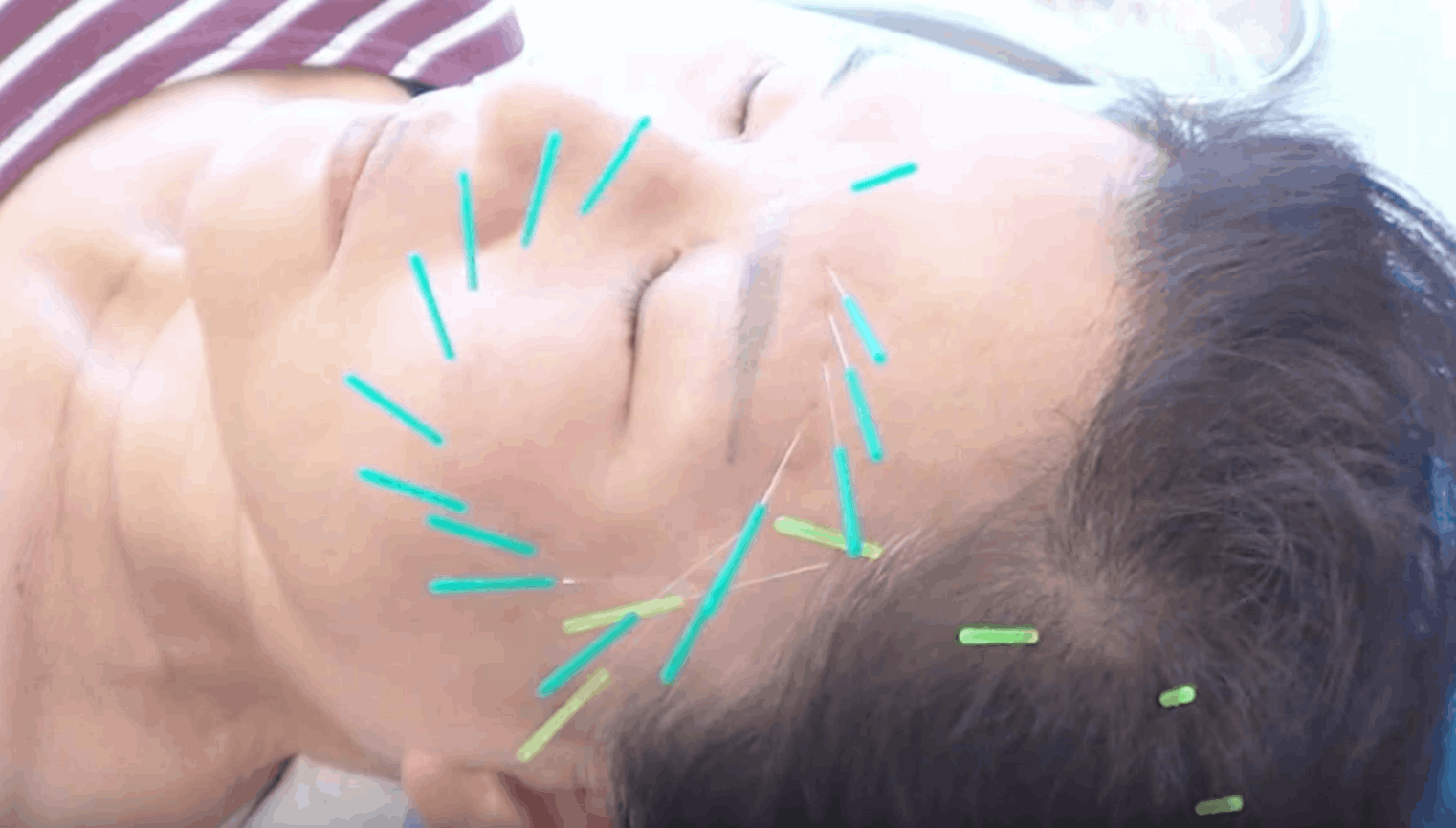 lifting du visage par acupuncture