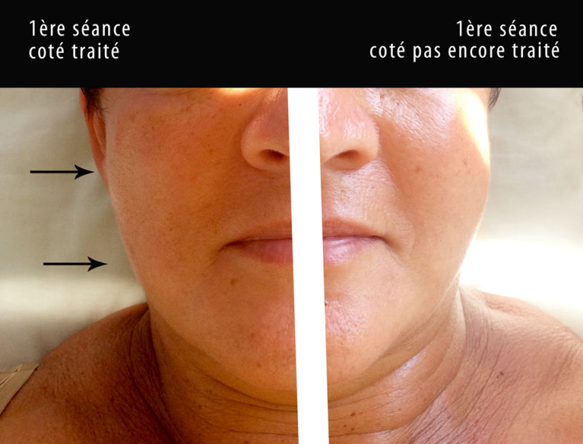 lifting du visage acupuncture marseille