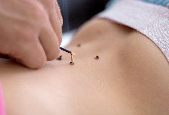 Moxibustion à Marseille (Okyu)